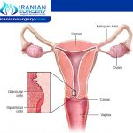 Cervical cancer staging and treatment