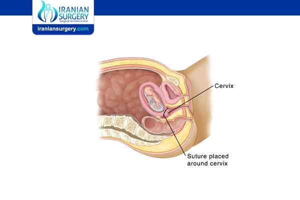 عملية ربط عنق الرحم بعد الولادة