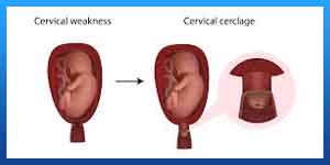 عملیة ربط عنق الرحم لمنع الحمل