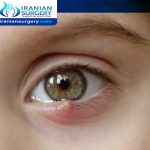Chalazion Treatment in Iran