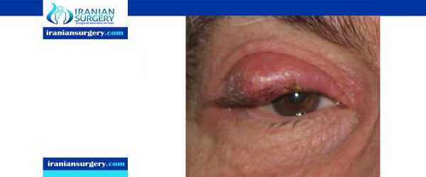 Chalazion surgery aftercare - Iranian Surgery