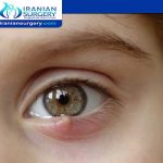 Chalazion surgery scar