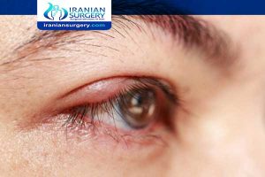 Chalazion surgery unsuccessful | chalazion surgery failure |Iranian Surgery