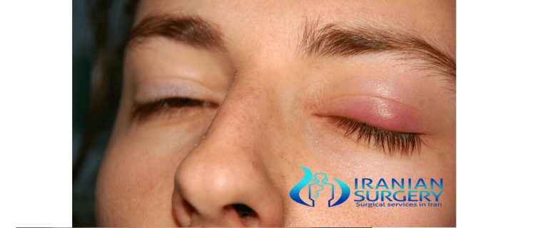 Chalazion Treatmentchalazion Surgerychalazion Causes Iranian Surgery 