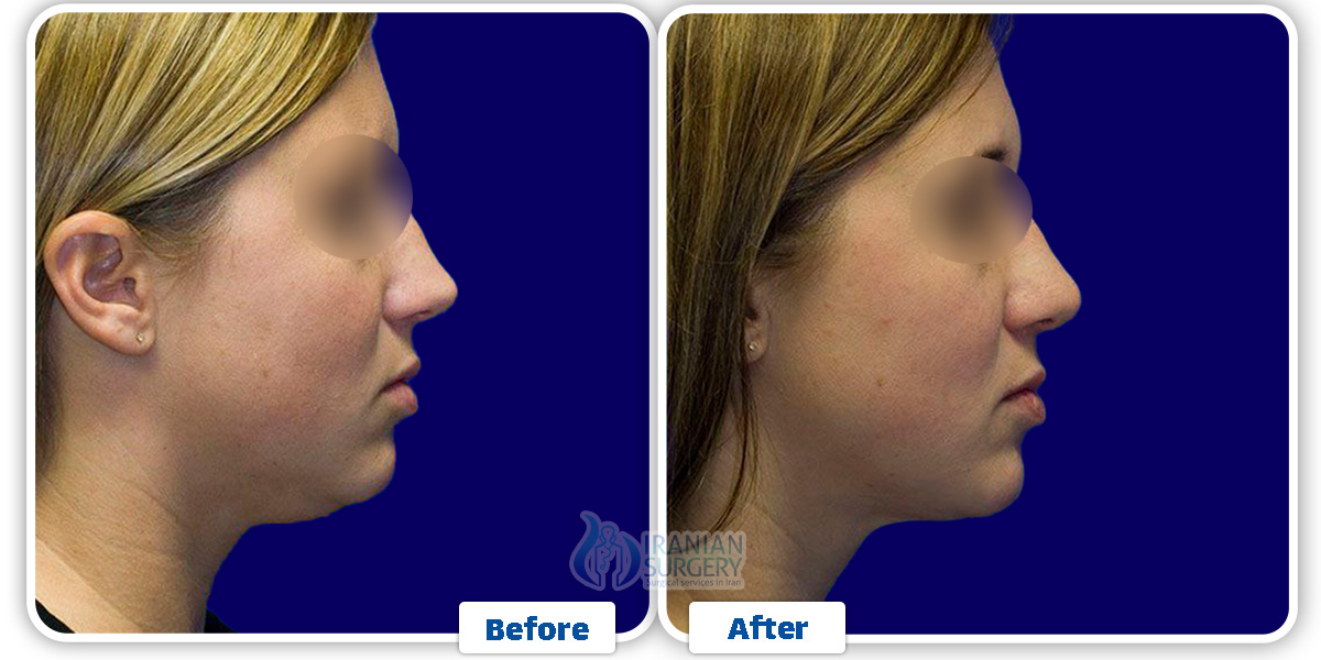 Chin Liposuction