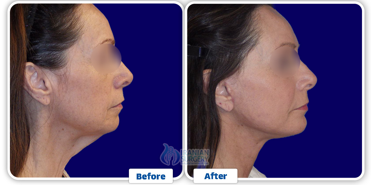 Chin Liposuction