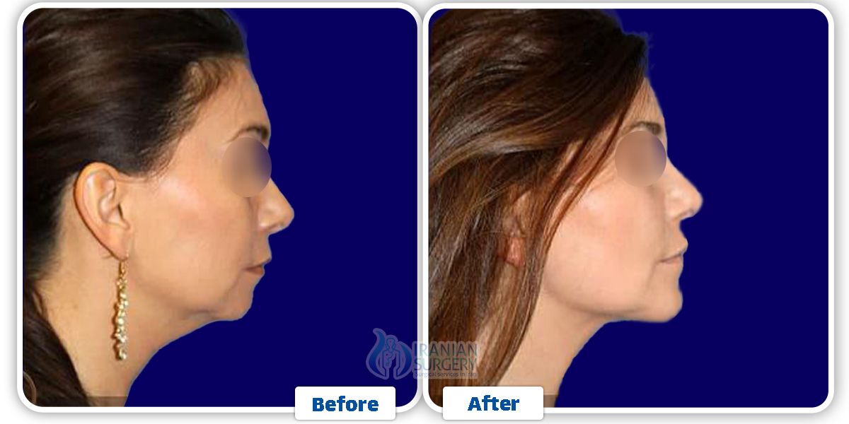 Chin Liposuction