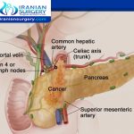 العلاج الكيماوي لسرطان البنكرياس