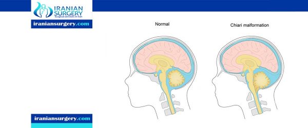 Chiari Malformation Treatment - Iranian Surgery