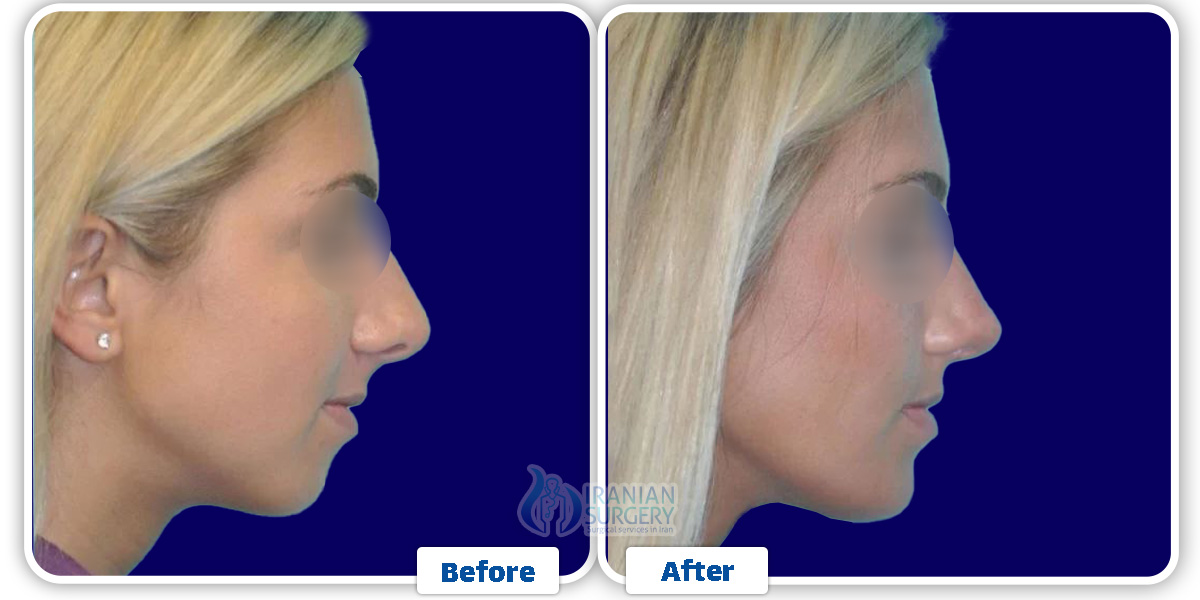 Chin Augmentation