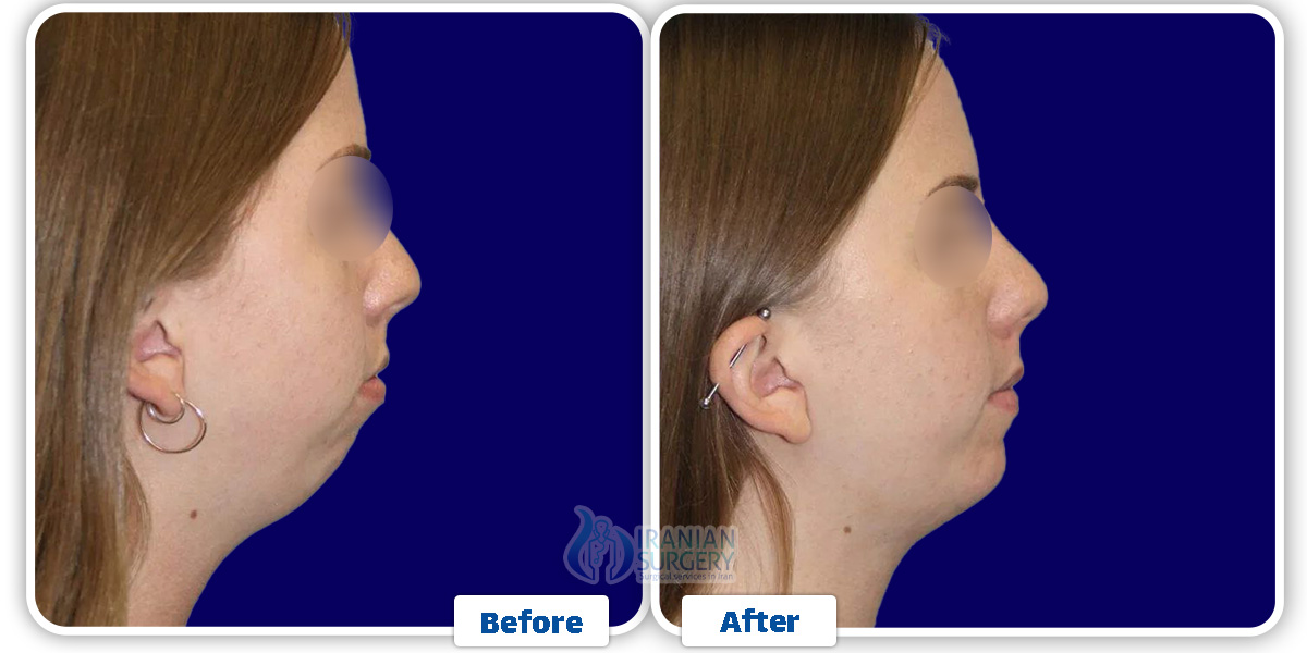 Chin Augmentation