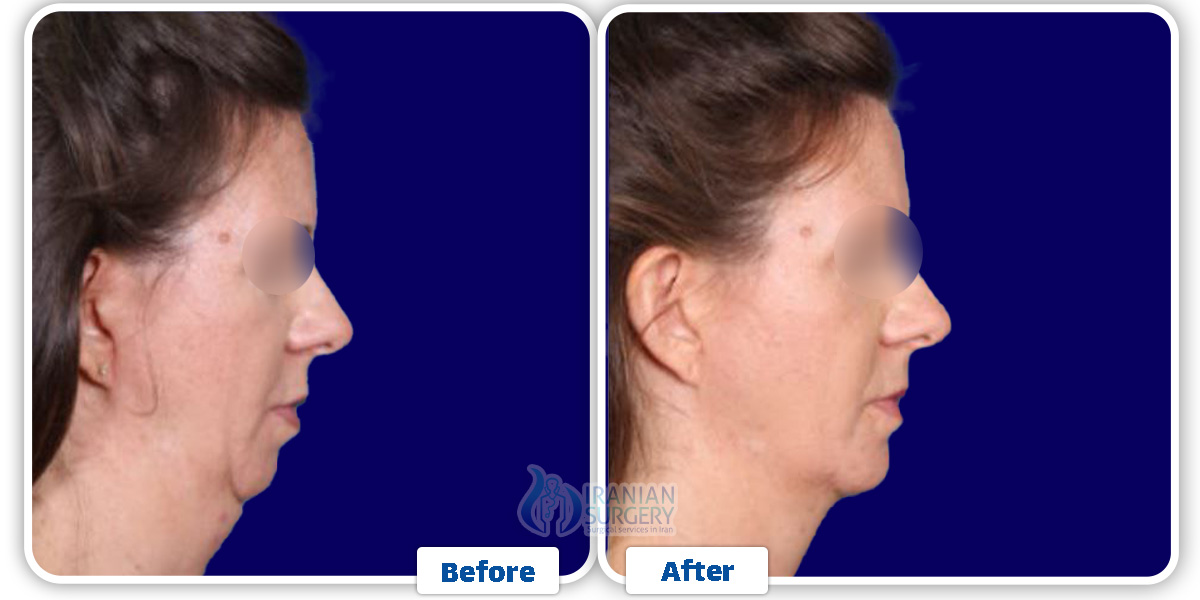 Chin Augmentation