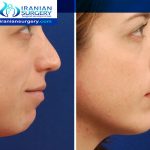 Chin augmentation