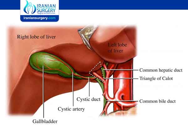 Cholecystectomy complications