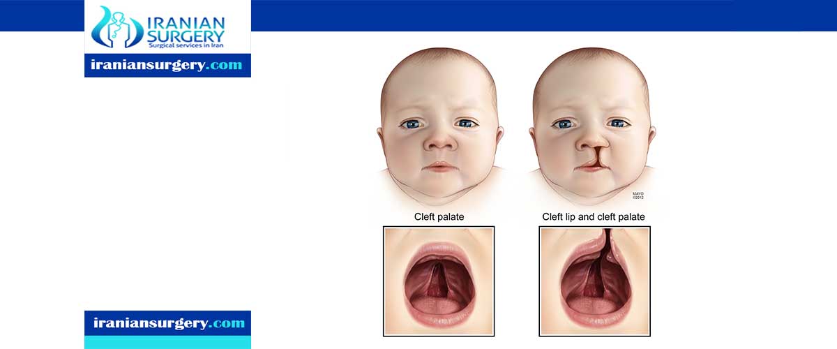 Cleft palate surgery age