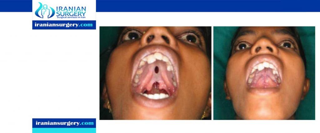 Cleft palate surgery complications
