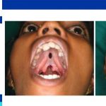 Cleft palate surgery complications