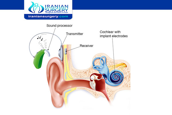 Cochlear implant parts