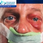Complications of Endoscopic Sinus Surgery