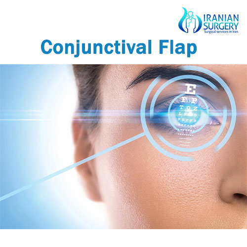 Conjunctival Flap Surgery In Iran Conjunctival Flap Cost Iranian Surgery