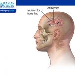 Cranioplasty side effects
