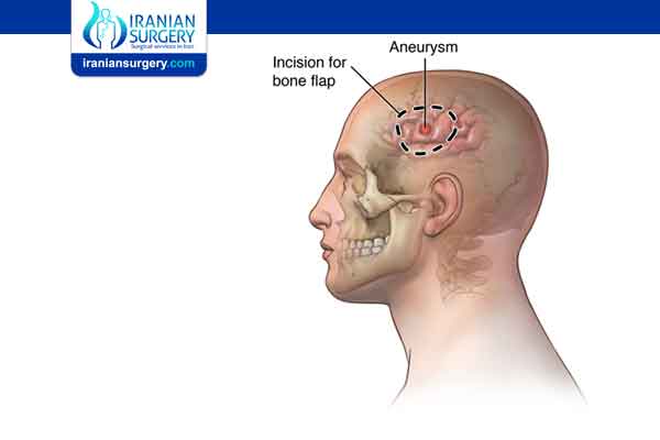 Cranioplasty side effects