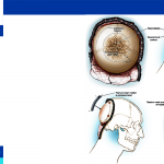 Cranioplasty surgery duration
