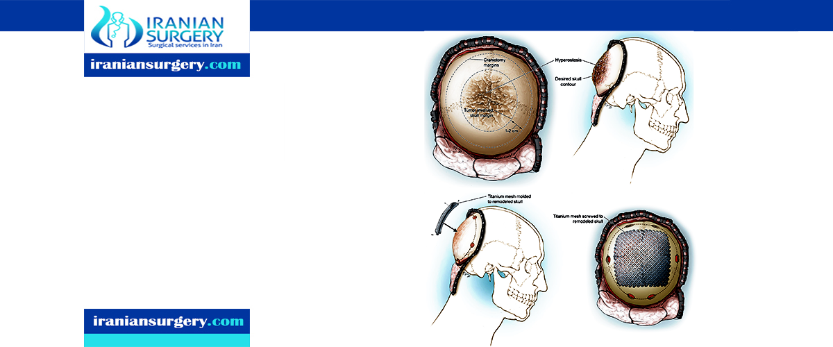 Cranioplasty surgery duration