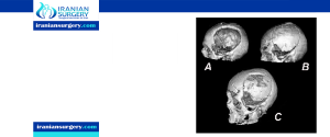 Cranioplasty surgery risks