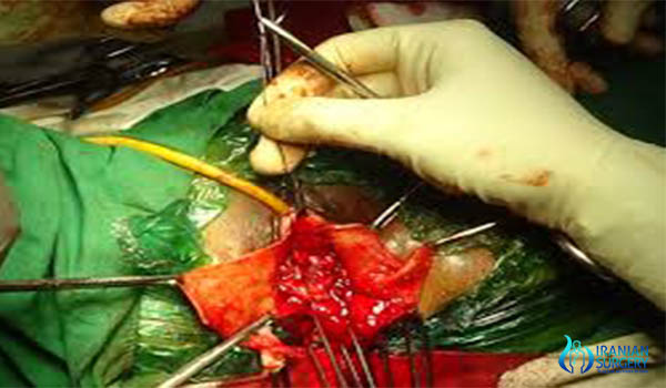 Cystocele-surgery-procedure-in-Iran