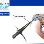 Cystoscopy procedure in Iran