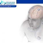 Deep Brain Stimulation Surgery