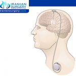 Deep Brain Stimulation for Parkinson’s disease