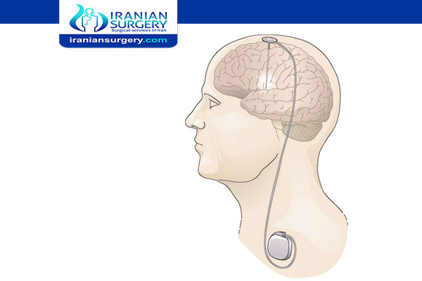 What is Deep Brain Stimulation Used for?