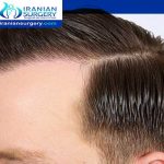 Dhi Hair Transplant