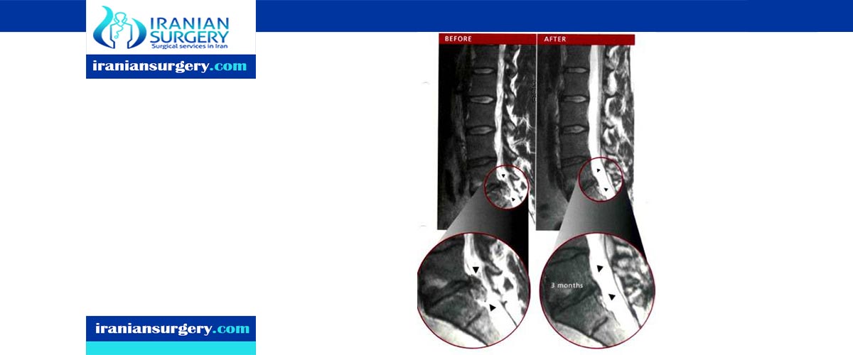 Disc Herniation Surgery Recovery
