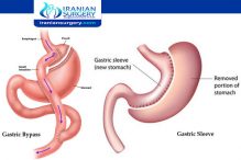 Duodenal Switch vs Sleeve | cons + pros + loss chart | Iranian Surgery