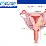 Endometrial cancer stage III