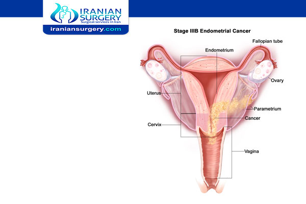 Endometrial cancer stage III