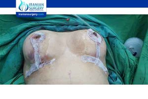 Read more about Fat transfer breast augmentation in Iran  Read more about How much fat do you need for fat transfer breast augmentation
