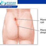 Exercise after pilonidal cyst surgery