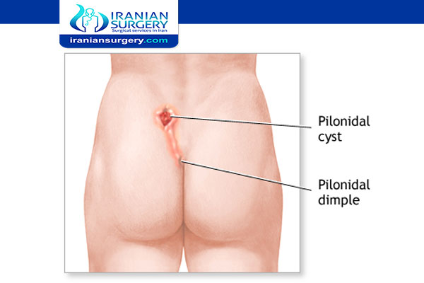 Exercise after pilonidal cyst surgery