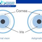 علاج استجماتيزم العين بالليزر