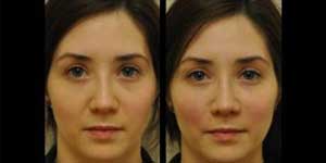 عملية توسيع العيون قبل و بعد