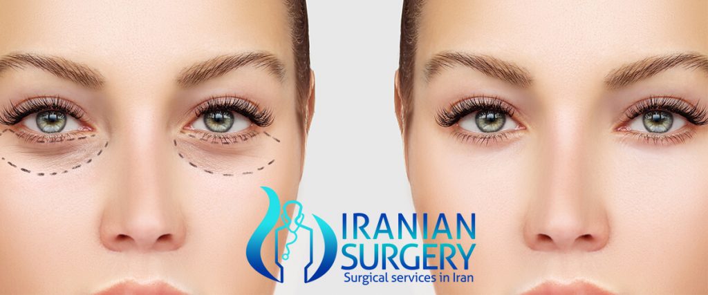 cat eye surgery Iranian Surgery