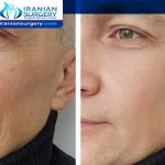 Facial fat transfer after 5 years