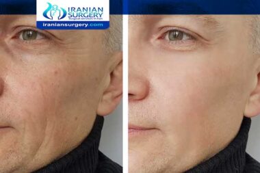 Facial fat transfer after 5 years