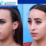 Facial feminization surgery