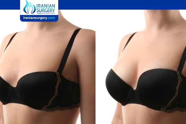 Fat transfer breast augmentation