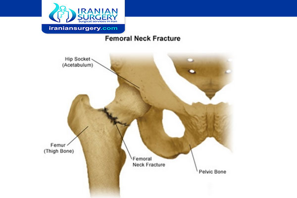 impacted fracture